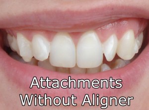 Attachments Without Aligner On