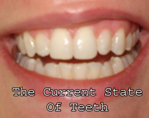 After 24 Refinement Trays